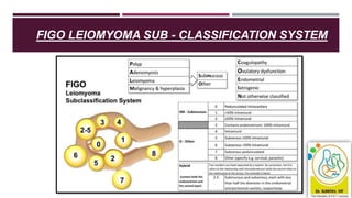 FIGO LEIOMYOMA SUB - CLASSIFICATION SYSTEM
 