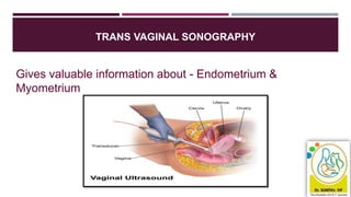 TRANS VAGINAL SONOGRAPHY
Gives valuable information about - Endometrium &
Myometrium
 
