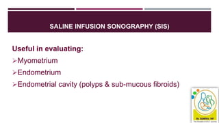 SALINE INFUSION SONOGRAPHY (SIS)
Useful in evaluating:
Myometrium
Endometrium
Endometrial cavity (polyps & sub-mucous fibroids)
 