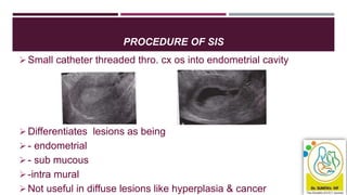PROCEDURE OF SIS
Small catheter threaded thro. cx os into endometrial cavity
Differentiates lesions as being
- endometrial
- sub mucous
-intra mural
Not useful in diffuse lesions like hyperplasia & cancer
 