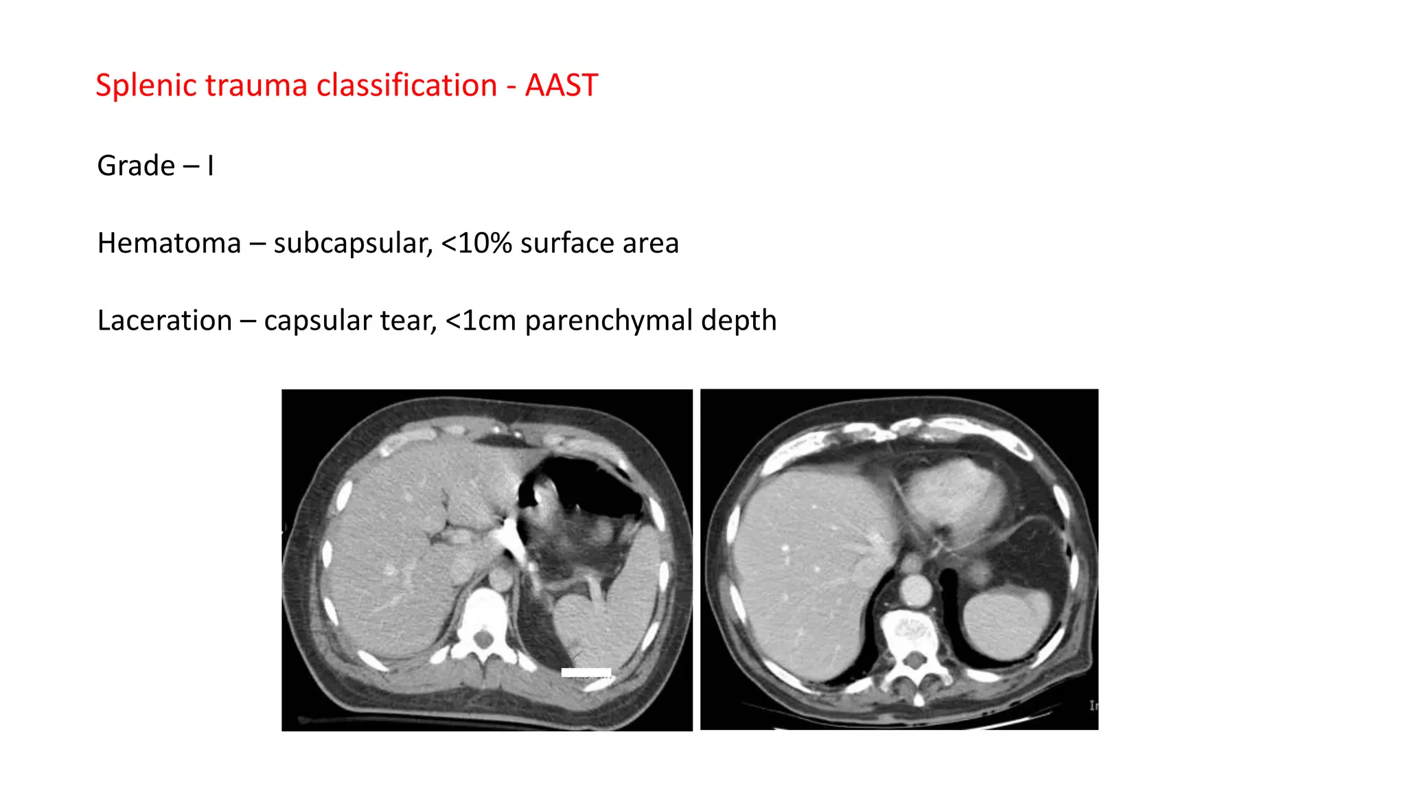 CME splenic injury.pptx