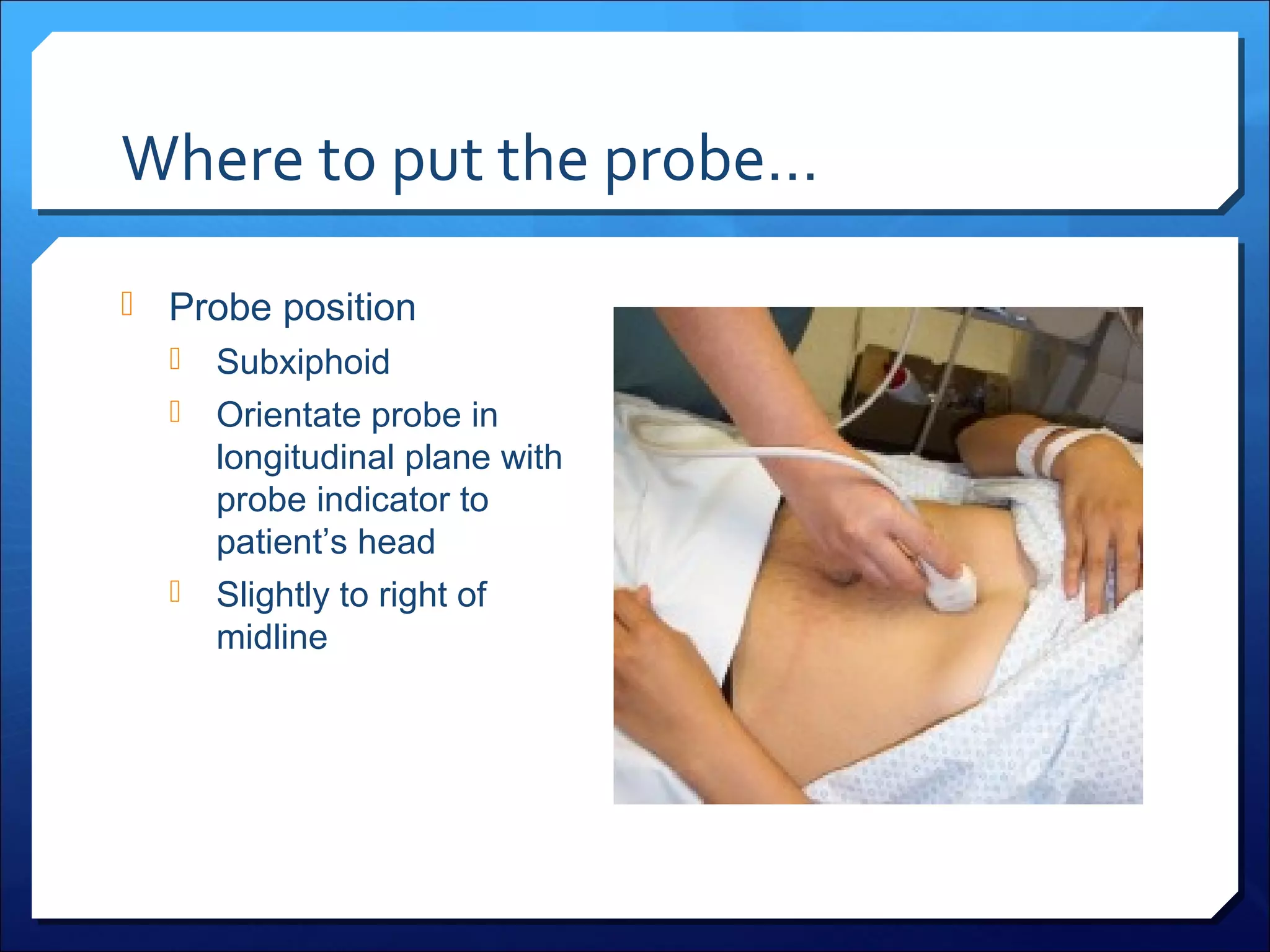 Where to put the probe…
 Probe position

Subxiphoid
 Orientate probe in
longitudinal plane with
probe indicator to
patient’s head
 Slightly to right of
midline


 