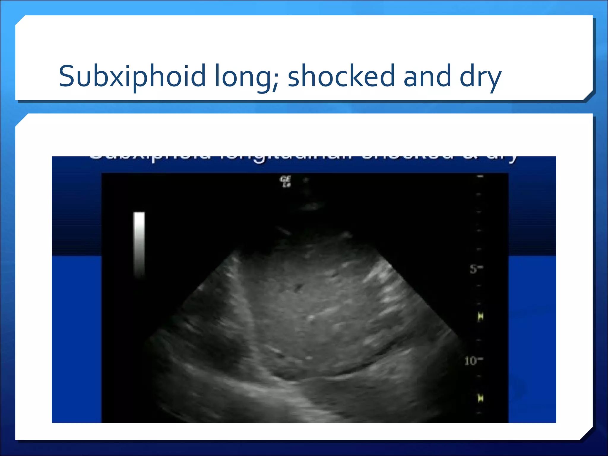 Subxiphoid long; shocked and dry

 