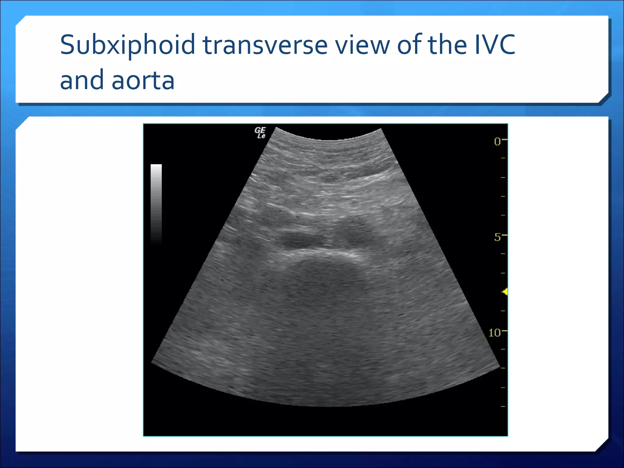 Subxiphoid transverse view of the IVC
and aorta

 