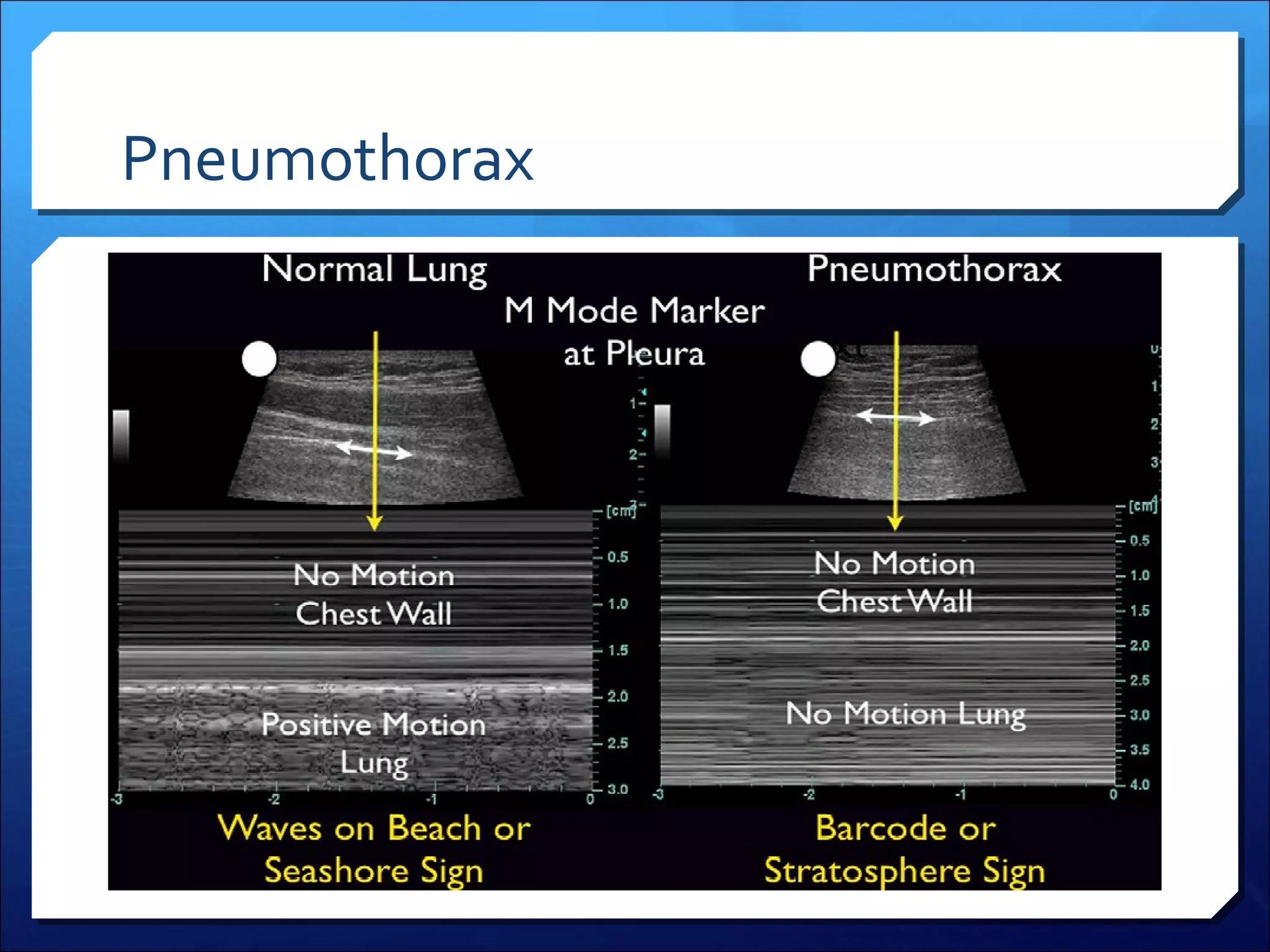 Pneumothorax

 