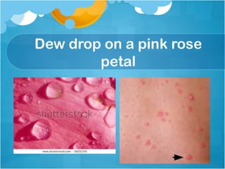 Diffuse Dew Drop Rash CME Varicella-zoster Infection in Paediatric.pdf