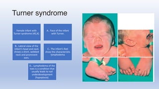Turner syndrome
Female infant with
Turner syndrome (45,X).
A.. Face of the infant
with Turner.
B.. Lateral view of the
infant’s head and neck
shows a short, webbed
neck and prominent
ears.
C.. The infant’s feet
show the characteristic
lymphedema
D… Lymphedema of the
toes is a condition that
usually leads to nail
underdevelopment
(hypoplasia).
 