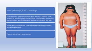 Turner syndrome (45,X) in a 14-year-old girl.
Features of the syndrome include short stature; a webbed neck;
absence of secondary sexual maturation; a broad chest with widely
spaced nipples; and lymphedema swelling of the hands and feet
Infants with this syndrome have defective gonadal development
(gonadal dysgenesis).
Present with primary amenorrhea
 