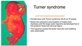 Turner syndrome
• Female fetus with Turner syndrome (45,X) at 16 weeks.
• Notice the excessive accumulation of watery fluid
(hydrops) and the large cystic hygroma (lymphangioma) in
the posterior head and cervical region.
• The hygroma causes the loose neck skin and webbing
seen postnatally
 