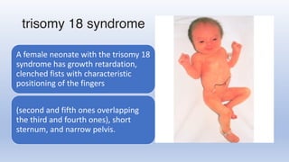 trisomy 18 syndrome
A female neonate with the trisomy 18
syndrome has growth retardation,
clenched fists with characteristic
positioning of the fingers
(second and fifth ones overlapping
the third and fourth ones), short
sternum, and narrow pelvis.
 