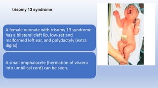 A female neonate with trisomy 13 syndrome
has a bilateral cleft lip, low-set and
malformed left ear, and polydactyly (extra
digits).
A small omphalocele (herniation of viscera
into umbilical cord) can be seen.
trisomy 13 syndrome
 