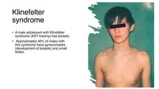 Klinefelter
syndrome
• A male adolescent with Klinefelter
syndrome (XXY trisomy) has breasts.
• Approximately 40% of males with
this syndrome have gynecomastia
(development of breasts) and small
testes.
 
