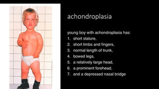 achondroplasia
young boy with achondroplasia has:
1. short stature,
2. short limbs and fingers,
3. normal length of trunk,
4. bowed legs,
5. a relatively large head,
6. a prominent forehead,
7. and a depressed nasal bridge
 
