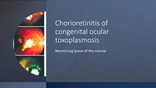 Chorioretinitis of
congenital ocular
toxoplasmosis
Necrotizing lesion of the macula
 