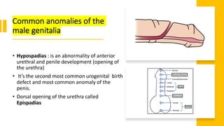 Common anomalies of the
male genitalia
• Hypospadias : is an abnormality of anterior
urethral and penile development (opening of
the urethra)
• It’s the second most common urogenital birth
defect and most common anomaly of the
penis.
• Dorsal opening of the urethra called
Epispadias
 
