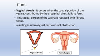Cont.
• Vaginal atresia : It occurs when the caudal portion of the
vagina, contributed by the urogenital sinus, fails to form.
• This caudal portion of the vagina is replaced with fibrous
tissue.
• resulting in uterovaginal outflow tract obstruction.
Normal vagina
Vaginal atresia
 
