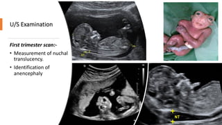 U/S Examination
First trimester scan:-
• Measurement of nuchal
translucency.
• Identification of
anencephaly
 