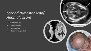 Second trimester scan(
Anomaly scan)
• CNS Anomaly..eg
Ø hydrocephalus
Ø anencephaly
Ø Straberry shape skull
 