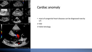 Cardiac anomaly
• most of congenital heart diseases can be diagnosed now by
u/s
ØVSD
ØFallot tetralogy.
This Photo by Unknown author is licensed under CC BY.
This Photo by Unknown author is licensed under CC BY.
 