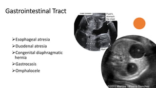 Gastrointestinal Tract
ØEsophageal atresia
ØDuodenal atresia
ØCongenital diaphragmatic
hernia
ØGastrocasis
ØOmphalocele
 
