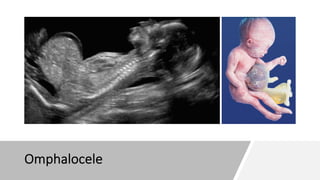 Omphalocele
 