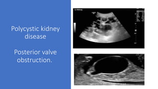 Polycystic kidney
disease
Posterior valve
obstruction.
 