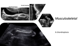 Musculoskeletal
A chondroplasia
 