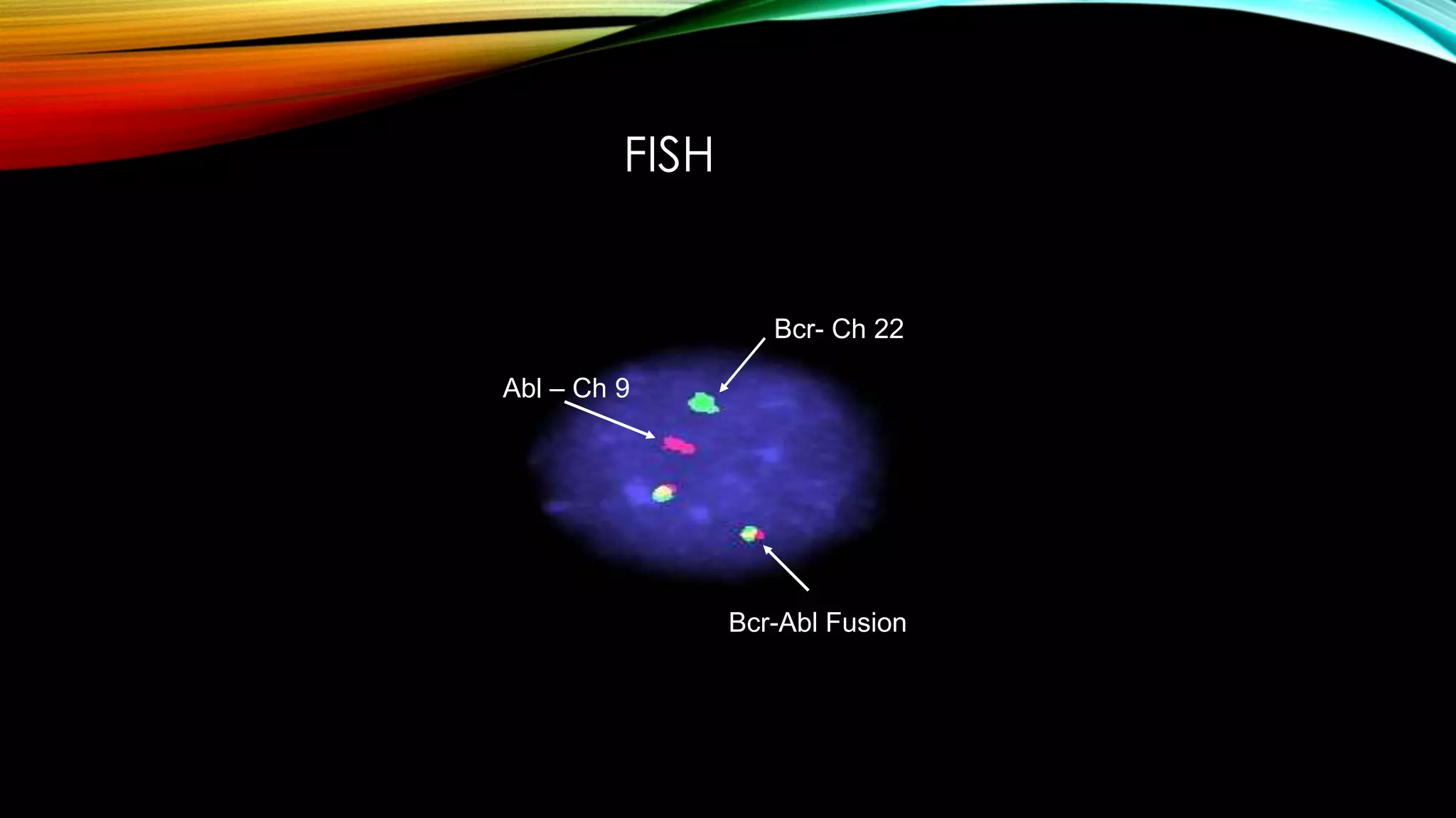 FISH

Bcr- Ch 22
Abl – Ch 9

Bcr-Abl Fusion

 