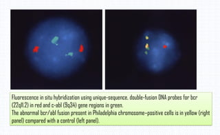 Fluorescence in situ hybridization using unique-sequence, double-fusion DNA probes for bcr
(22q11.2) in red and c-abl (9q34) gene regions in green.
The abnormal bcr/abl fusion present in Philadelphia chromosome–positive cells is in yellow (right
panel) compared with a control (left panel).
 