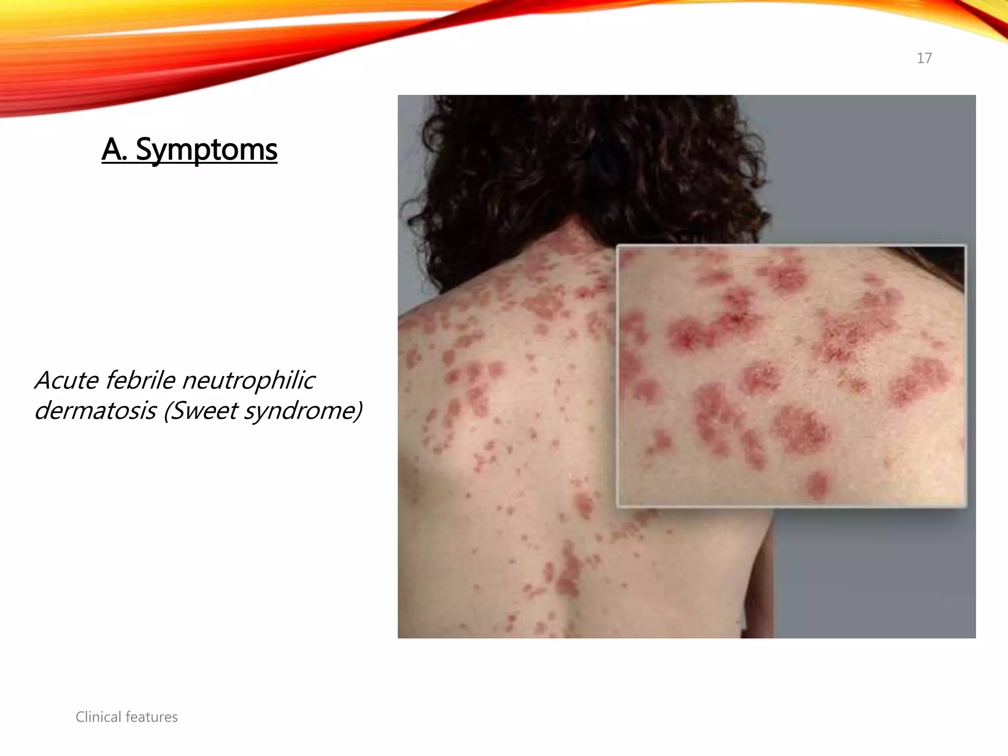 Clinical features
17
Acute febrile neutrophilic
dermatosis (Sweet syndrome)
A. Symptoms
 