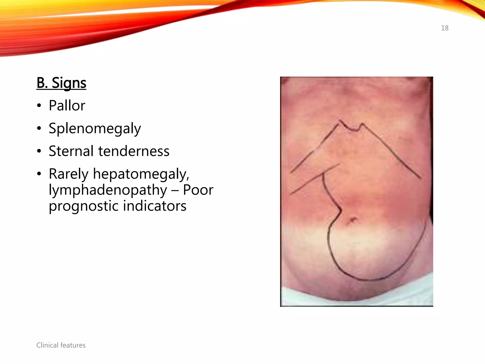 B. Signs
• Pallor
• Splenomegaly
• Sternal tenderness
• Rarely hepatomegaly,
lymphadenopathy – Poor
prognostic indicators
Clinical features
18
 