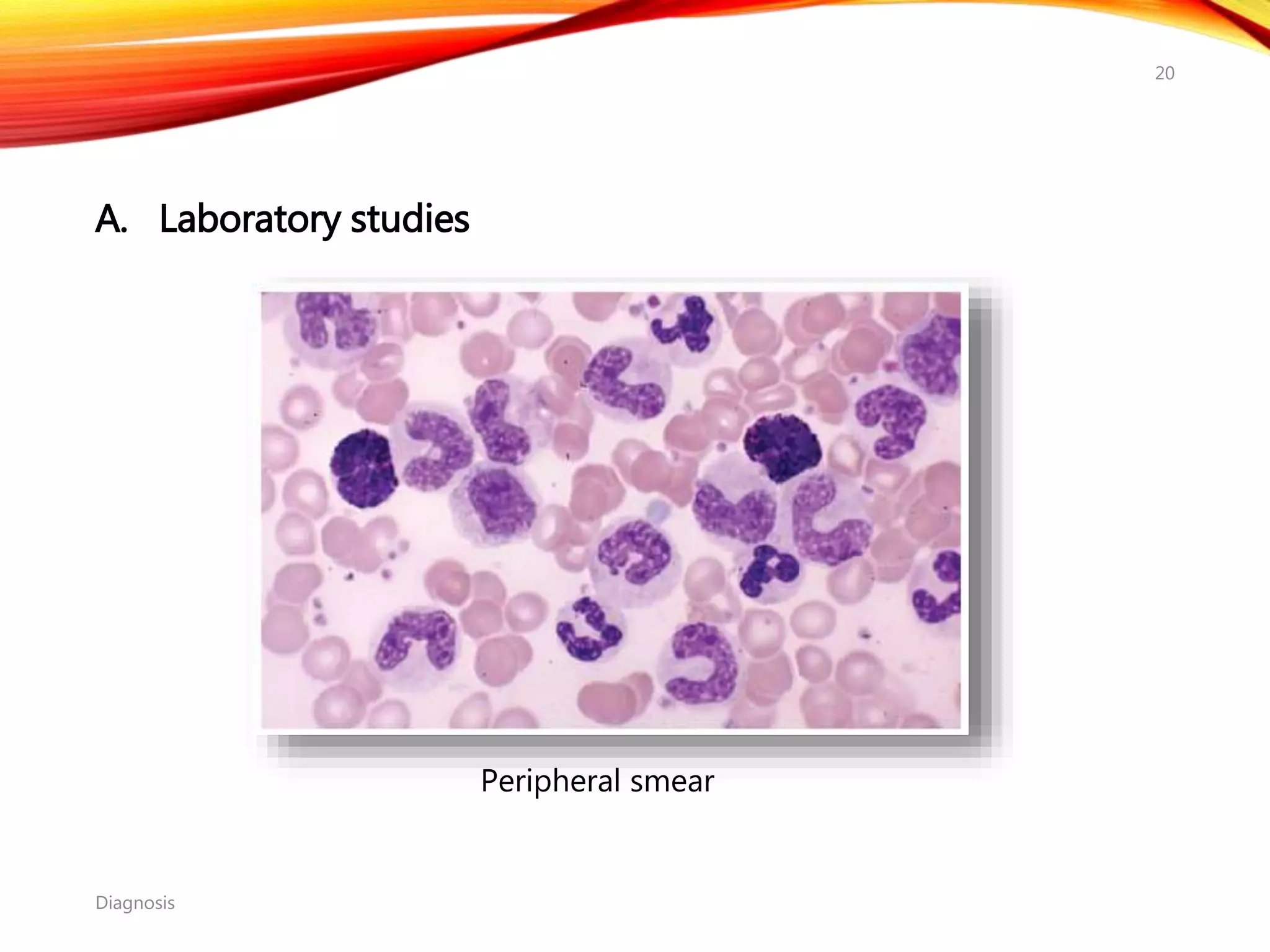 A. Laboratory studies
Diagnosis
20
Peripheral smear
 