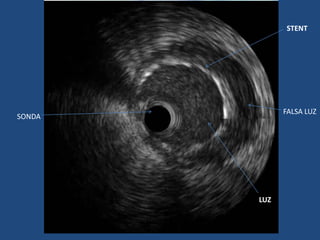 STENT




              FALSA LUZ
SONDA




        LUZ
 