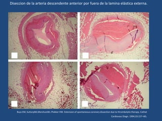 Diseccion de la arteria descendente anterior por fuera de la lamina elástica externa.




    Buys EM, SuttorpMJ,MorshuisWJ, Plokker HW. Extension of spontaneous coronary dissection due to thrombolytic therapy. Cathet
                                                                                             Cardiovasc Diagn. 1994;33:157–60   .
 