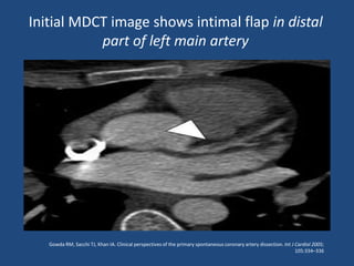 Initial MDCT image shows intimal flap in distal
           part of left main artery




   Gowda RM, Sacchi TJ, Khan IA. Clinical perspectives of the primary spontaneous coronary artery dissection. Int J Cardiol 2005;
                                                                                                                    105:334–336
 