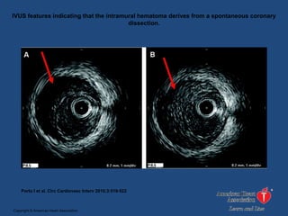 IVUS features indicating that the intramural hematoma derives from a spontaneous coronary
                                         dissection.




    Porto I et al. Circ Cardiovasc Interv 2010;3:519-522



Copyright © American Heart Association
 