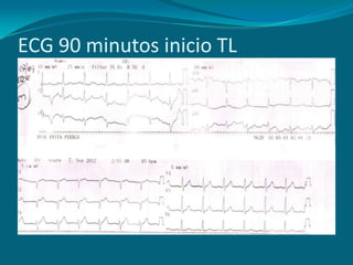 ECG 90 minutos inicio TL
 