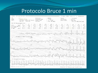 Protocolo Bruce 1 min
 