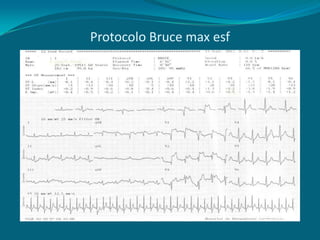 Protocolo Bruce max esf
 