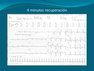 4 minutos recuperación
 