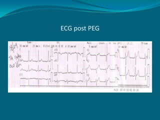 ECG post PEG
 