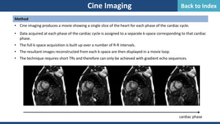 Cine Imaging
Method
• Cine imaging produces a movie showing a single slice of the heart for each phase of the cardiac cycle.
• Data acquired at each phase of the cardiac cycle is assigned to a separate k-space corresponding to that cardiac
phase.
• The full k-space acquisition is built up over a number of R-R intervals.
• The resultant images reconstructed from each k-space are then displayed in a movie loop.
• The technique requires short TRs and therefore can only be achieved with gradient echo sequences.
cardiac phase
Back to Index
 