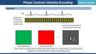 Phase Contrast Velocity Encoding
Acquisition
Each heart phase interval
includes two acquisitions
Single slice
at multiple
points in the
cardiac cycle
Flow sensitivity 1
ECG
Flow sensitivity 2
- =
Each frame is acquired with two flow sensitivities which are subtracted (to correct for phase
offsets due to other effects) to create the final phase map
Back to Index
 