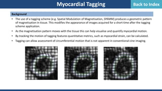 Myocardial Tagging
Background
• The use of a tagging scheme (e.g. Spatial Modulation of Magnetisation, SPAMM) produces a geometric pattern
of magnetisation in tissue. This modifies the appearance of images acquired for a short time after the tagging
scheme application.
• As the magnetisation pattern moves with the tissue this can help visualise and quantify myocardial motion.
• By tracking the motion of tagging features quantitative metrics, such as myocardial strain, can be calculated.
• Tagging can allow assessment of circumferential motion that is not apparent in conventional cine imaging.
Back to Index
 