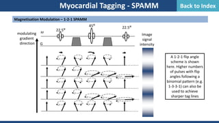 Magnetisation Modulation – 1-2-1 SPAMM
Myocardial Tagging - SPAMM
22.5°
22.5°
45°
G
modulating
gradient
direction
RF
Image
signal
intensity
A 1-2-1 flip angle
scheme is shown
here. Higher numbers
of pulses with flip
angles following a
binomial pattern (e.g.
1-3-3-1) can also be
used to achieve
sharper tag lines
Back to Index
 