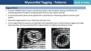 Myocardial Tagging - Patterns
Tagging Patterns
• The basic SPAMM scheme imparts a parallel lines pattern with the tag line spacing controlled by the
modulating gradient strength (a stronger gradient leads to closer tag line spacing).
• A second preparation phase can be applied with a perpendicular modulating gradient to achieve a grid
pattern.
• Alternative tagging patterns (e.g. radial) have also been used.
• In the images below the tag lines are distorted in the myocardium due to motion between tagging and image
data acquisition, but have maintained their original pattern in neighbouring stationary tissue.
Back to Index
 