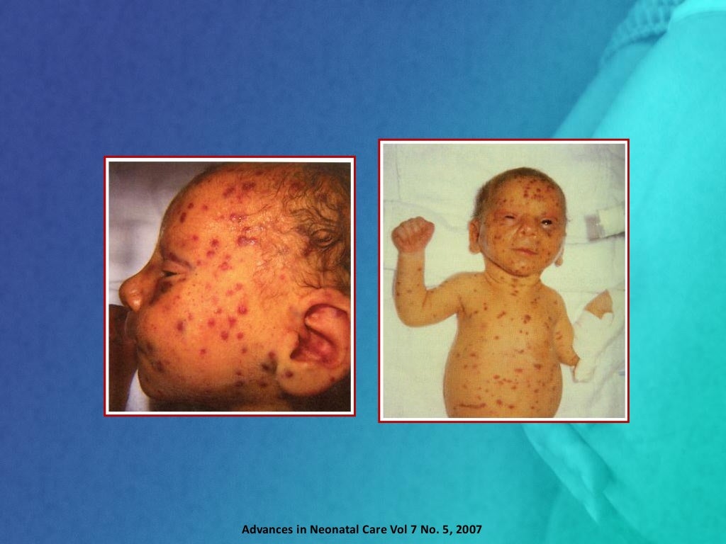 Citomegalovirus congénito