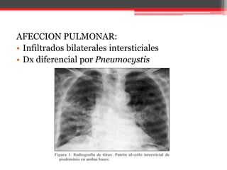 AFECCION PULMONAR:
• Infiltrados bilaterales intersticiales
• Dx diferencial por Pneumocystis
 