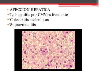 • AFECCION HEPATICA
La hepatitis por CMV es frecuente
Colecistitis acalculosas
Suprarrenalitis
 