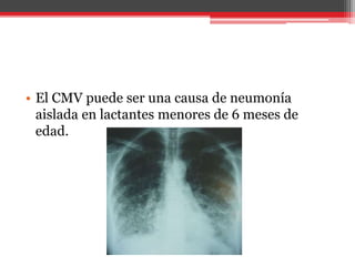 • El CMV puede ser una causa de neumonía
aislada en lactantes menores de 6 meses de
edad.
 